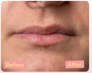Results of using Trew Cosmetic PeelLip Peeling Aha 5% Marine Bha